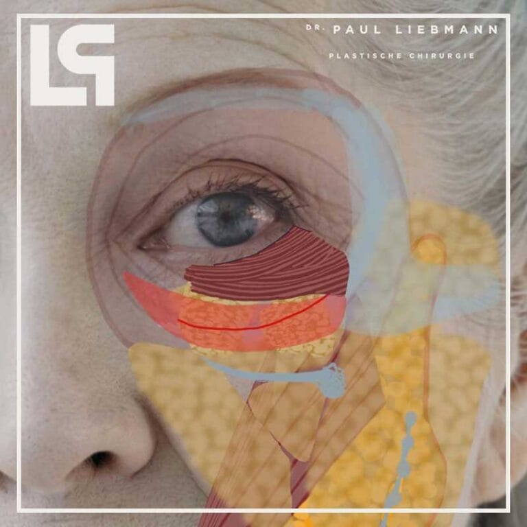 Unterlid - Tränensäcke