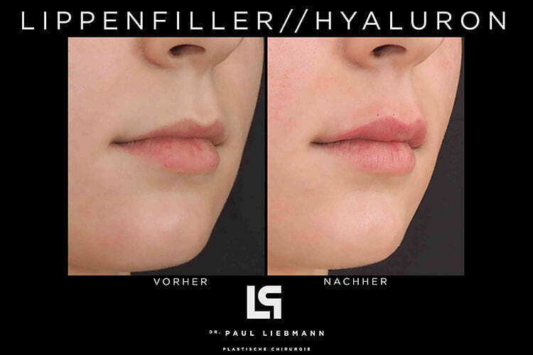 Bild zeigt Lippenfiller