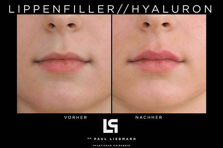 Bild zeigt Lippen frontal