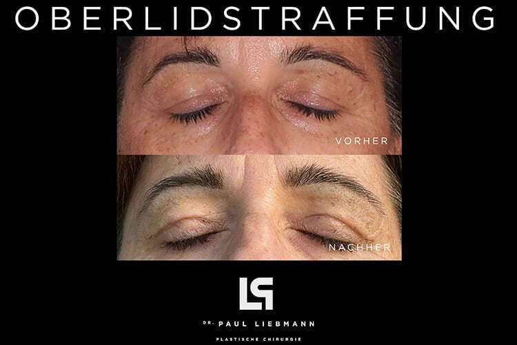 Oberlidstraffung