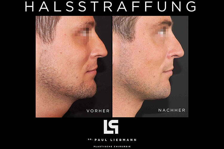 Vorher Nachher Bild Halsstraffung