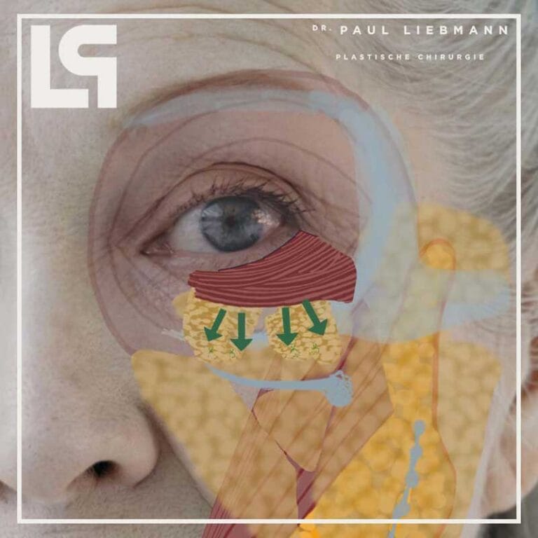 Unterlid - Tränensäcke