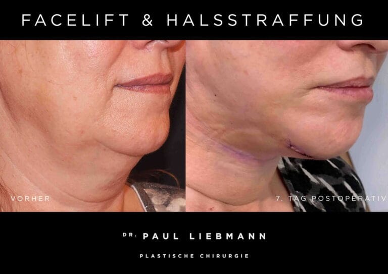 Foto Patientin Halslift vorher nachher
