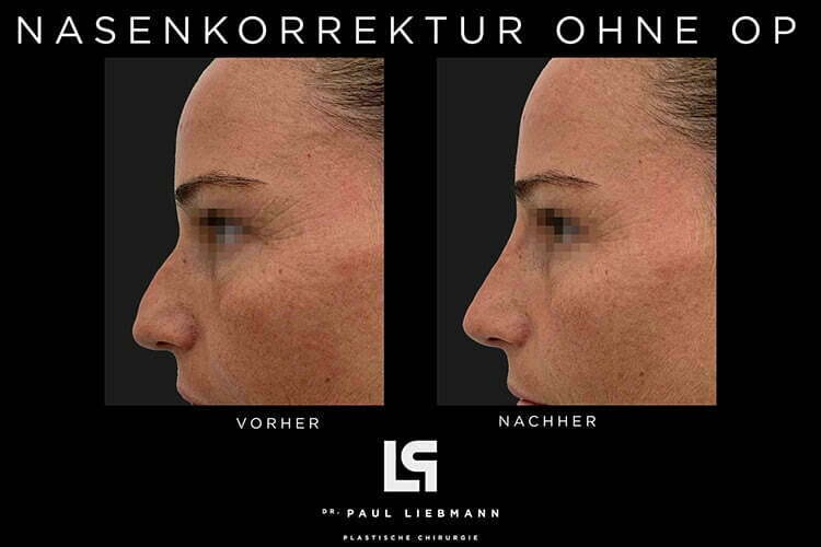 Nasenkorrektur ohne OP
