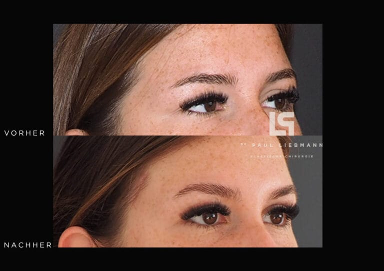 Nahaufnahme des Gesichts einer Frau nach Oberlidstraffung und Brauenanhebung
