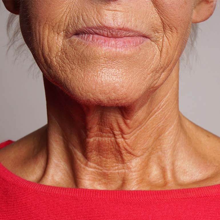 Nahaufnahme Hals einer Frau vor Halsstraffung (Facelift)