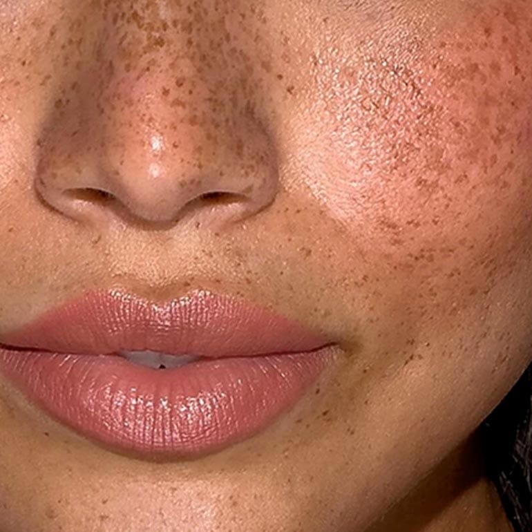 Gesicht Microneedling