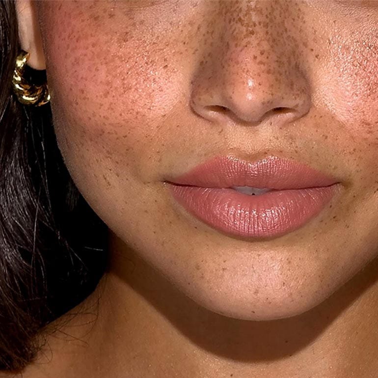 Nahaufnahme des Mundes einer Frau nach Filler-Behandlung