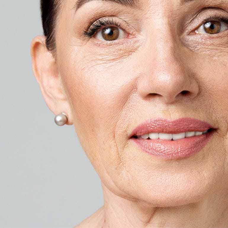 Nahaufnahme des Gesichts einer Frau nach Fadenlifting