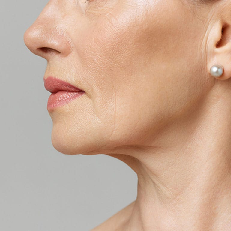 Frau nach Halslifting (Facelift)