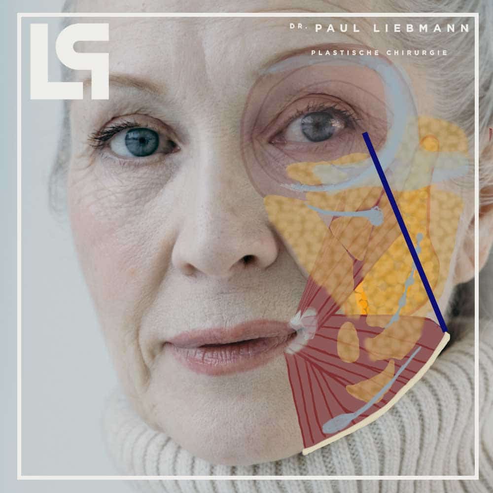 Drliebmann Facelift