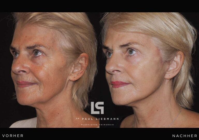 Vorher-Nachher-Bild einer Frau (Facelift)