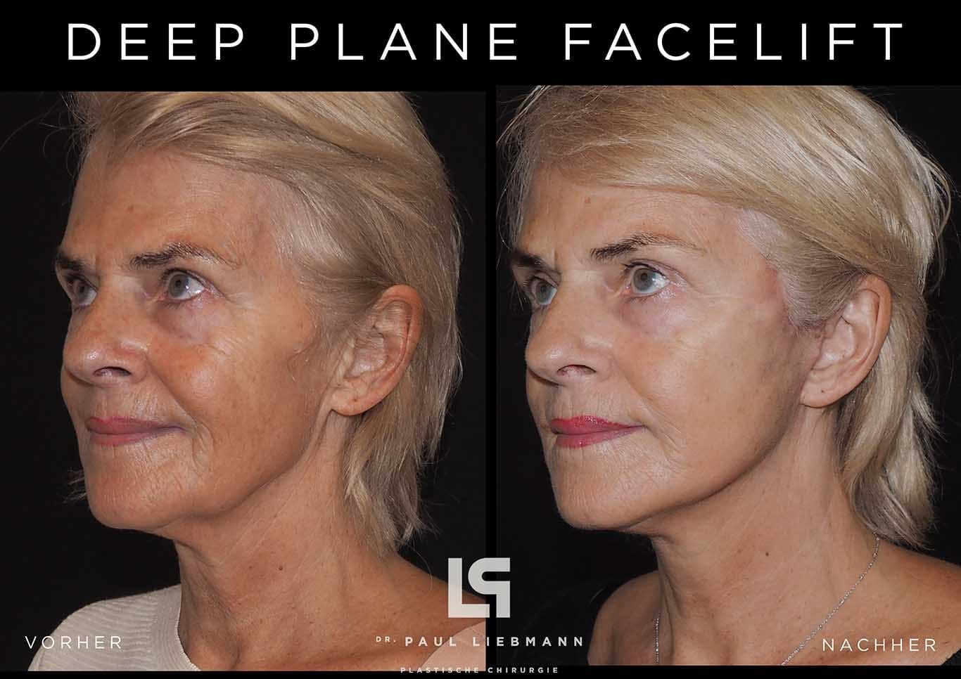 Bild zeigt Zustand nach Facelift in Schrägansicht