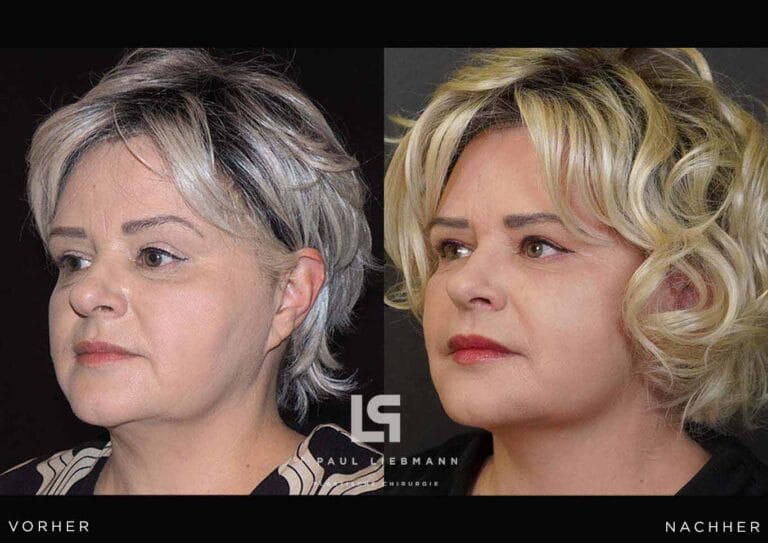 Schrägansicht Halsstra (Facelift)ffung