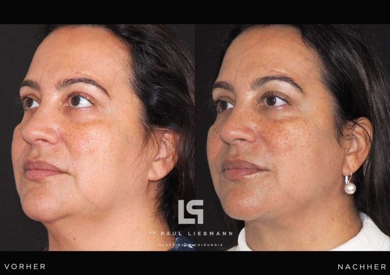 Halsstraffung Frau (Facelift)