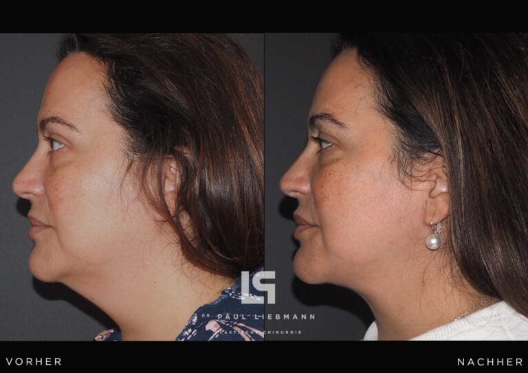 Bild zeigt Frau nach Hals (Facelift)straffung