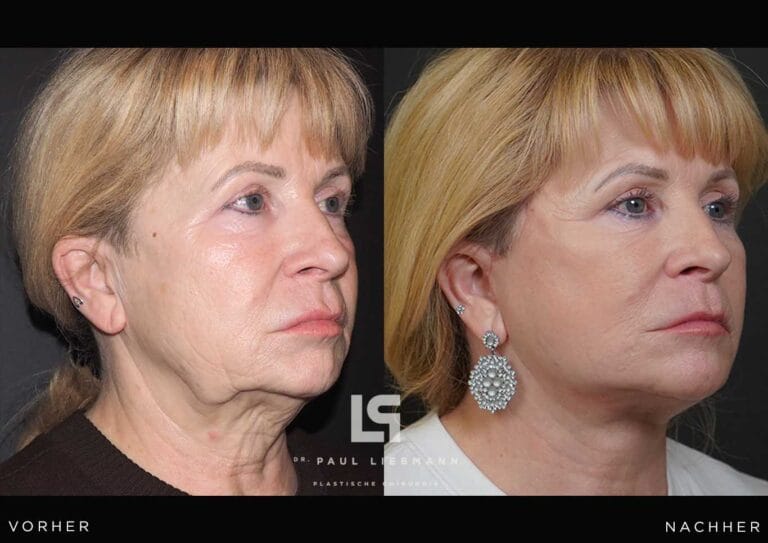 Vorher-Nachher-Bild einer Frau (Facelift)