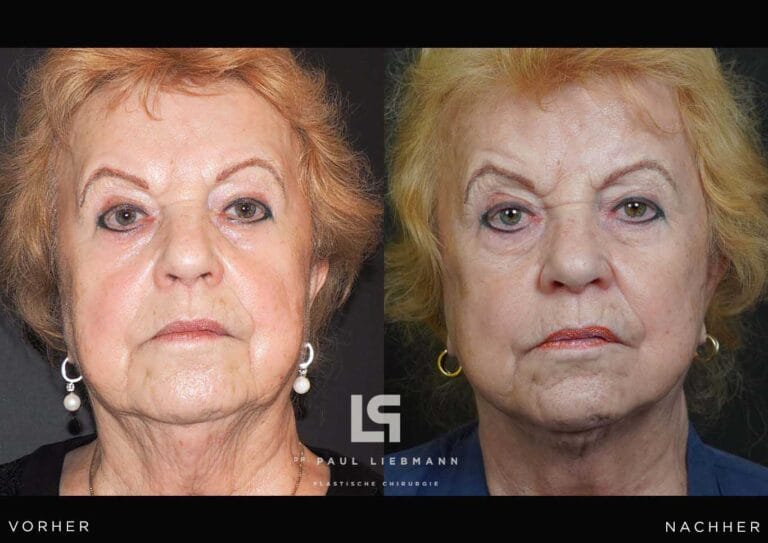 Vorher-Nachher-Bild einer Frau (Facelift)
