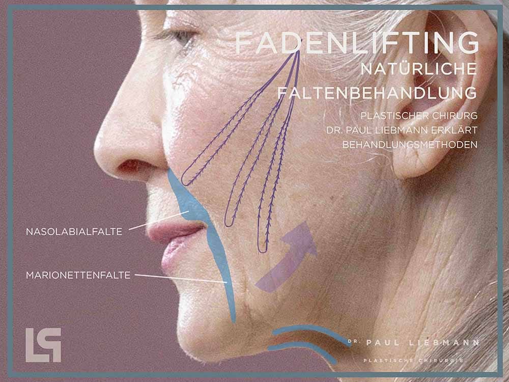 Fadenlifting Behandlung