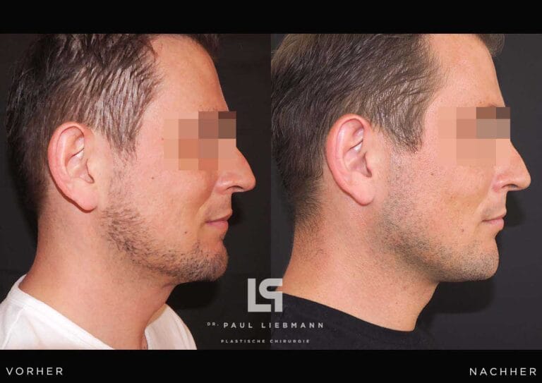 Halsstraffung Mann (Facelift)