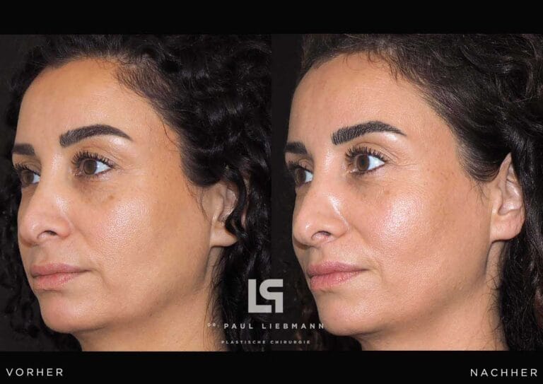 Vorher Nachher Liplift