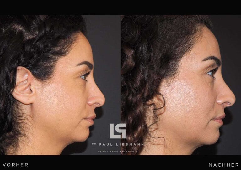 Vorher Nachher Liplift