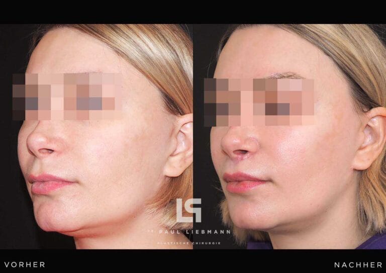 Vorher Nachher Liplift