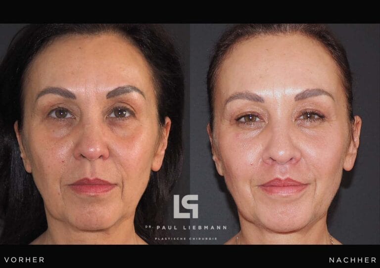 Vorher-Nachher-Bild einer Frau