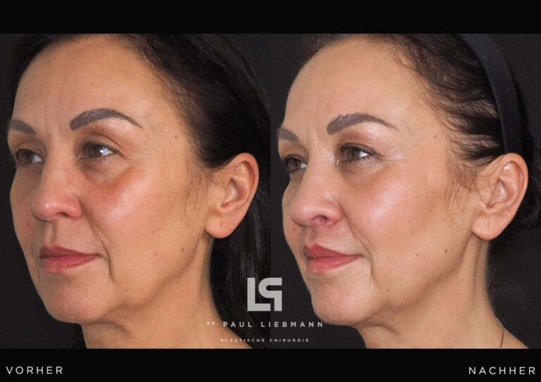 Vorher-Nachher-Bild einer Frau