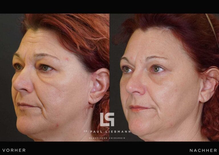 Vorher-Nachher-Nahaufnahme des Gesichts einer Frau nach Oberlidstraffung