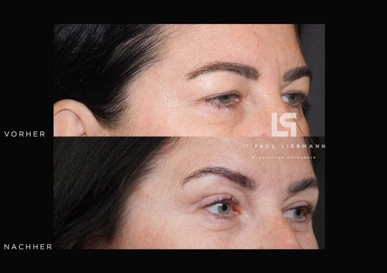 Vorher-Nachher-Nahaufnahme der Augenpartie einer Frau