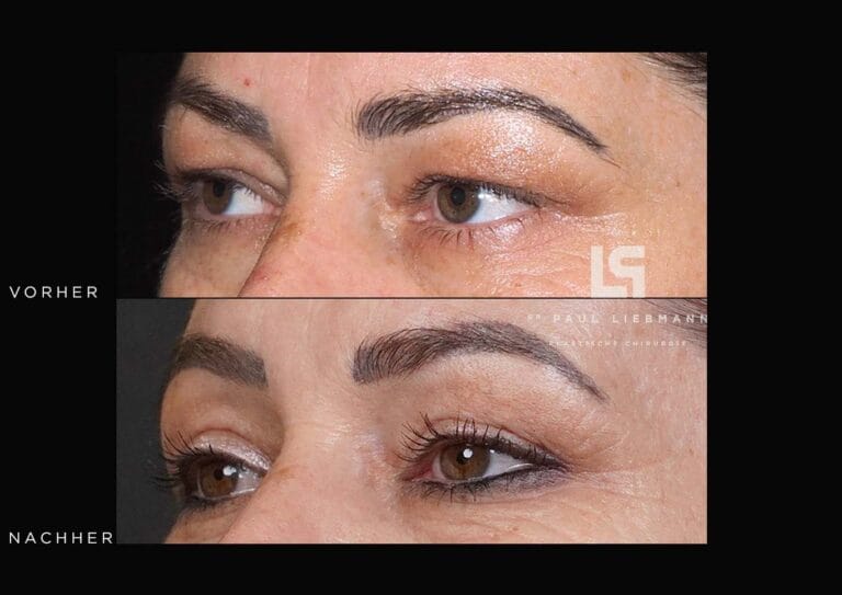 Vorher-Nachher-Nahaufnahme der Augenpartie einer Frau