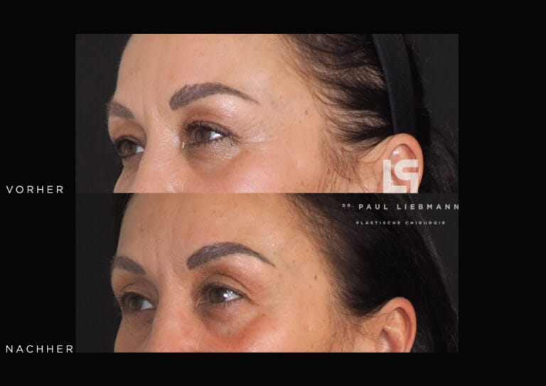 Vorher-Nachher-Nahaufnahme der Augenpartie einer Frau