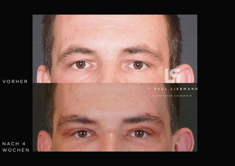 Nahaufnahme des Gesichts einer Frau nach Oberlidstraffung und Brauenanhebung