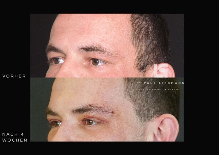 Vorher-Nachher-Nahaufnahme des Gesichts eines Mannes nach Oberlidstraffung und Brauenanhebung