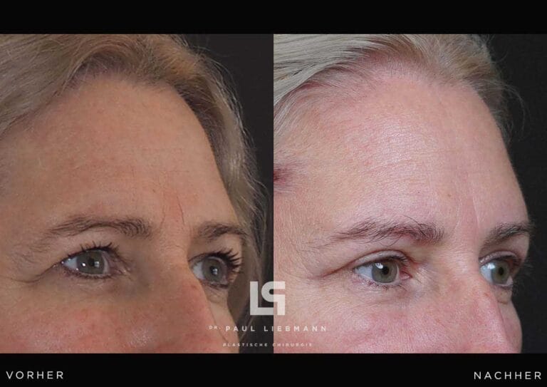 Vorher-Nachher-Nahaufnahme des Gesichts einer Frau nach Oberlidstraffung und Brauenanhebung