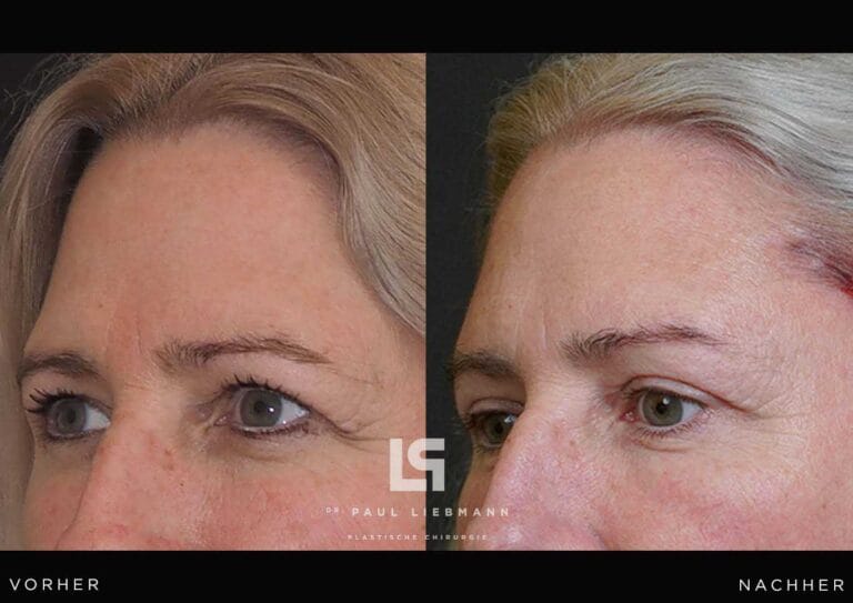 Nahaufnahme des Gesichts einer Frau nach Oberlidstraffung und Brauenanhebung