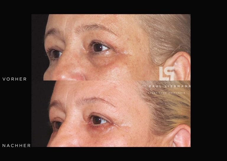 Vorher-Nachher-Nahaufnahme der Augenpartie einer Frau