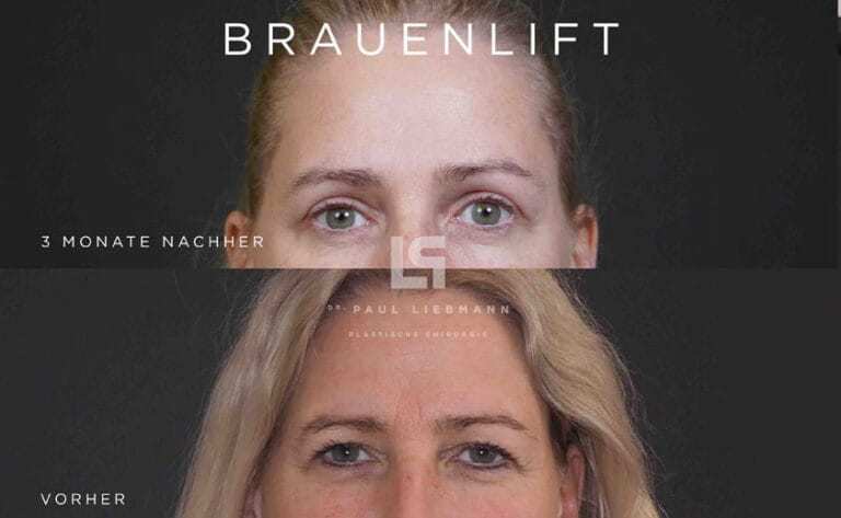 Augenbrauen anheben