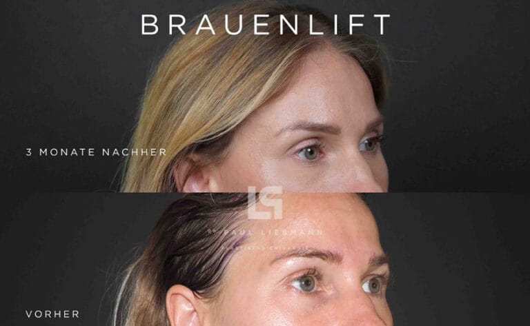 Augenbrauenlifting