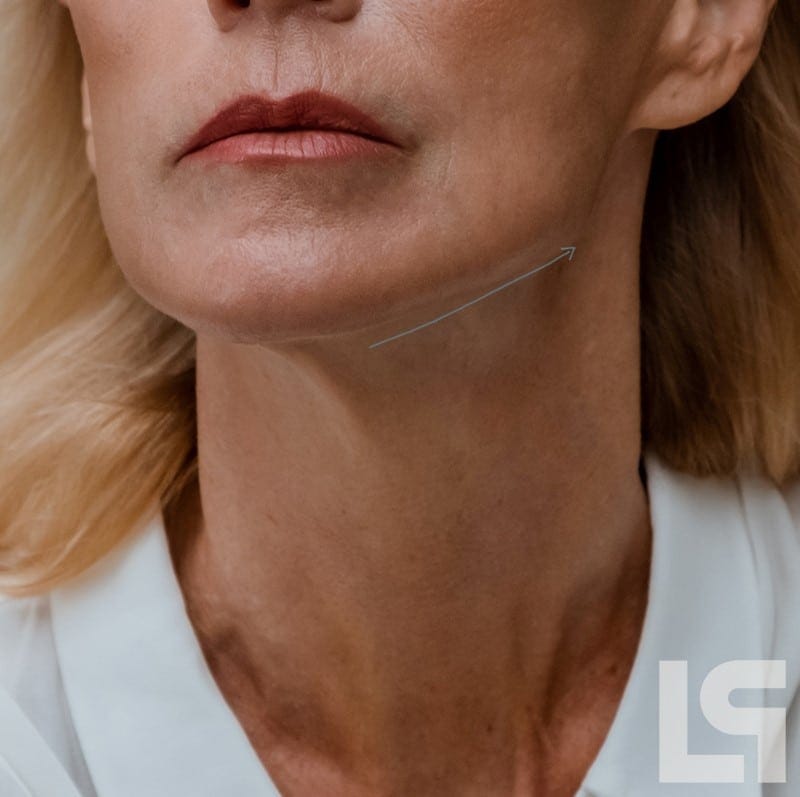 Straffe Haut unterkiefer