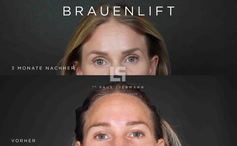 Brauenlift vorher nachher