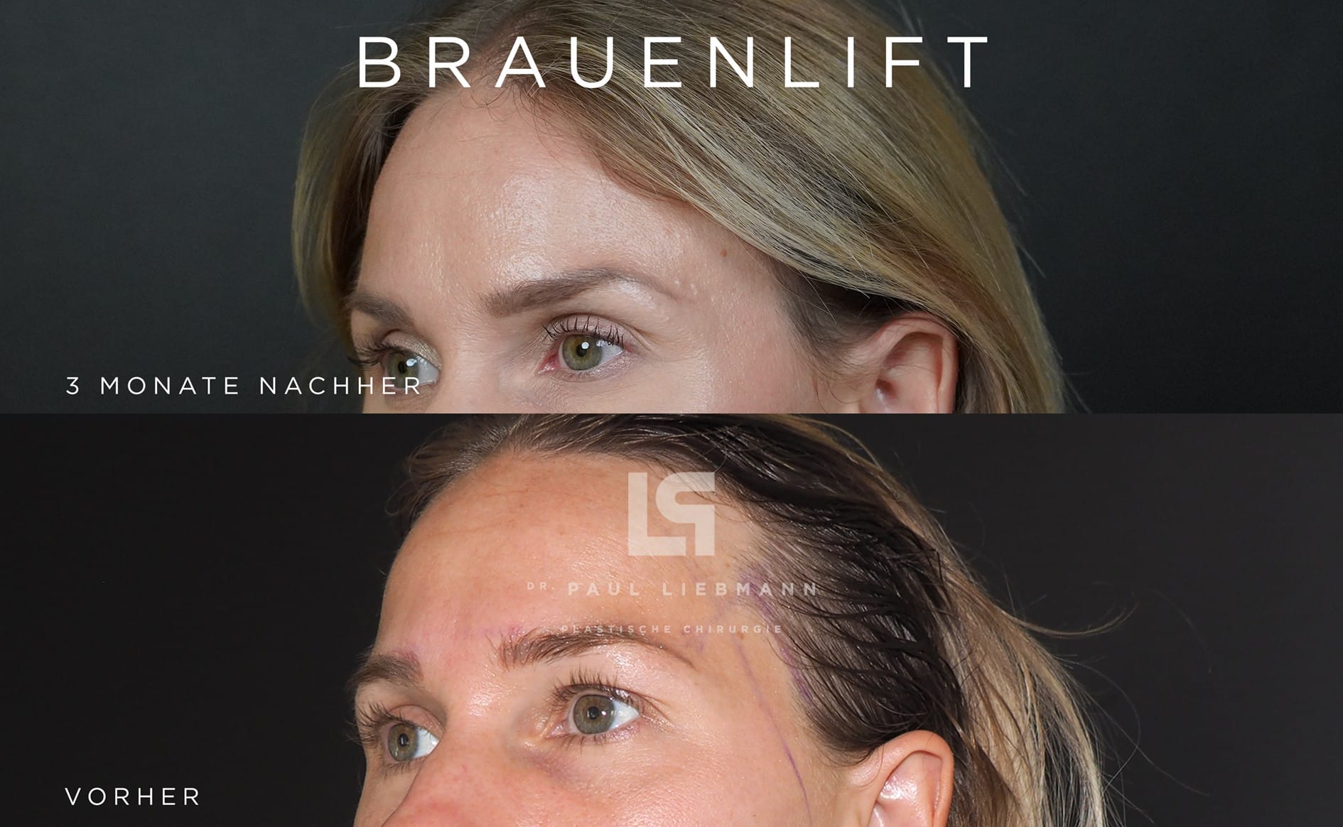 Augenbrauen geliftet vorher und nach 3 monaten