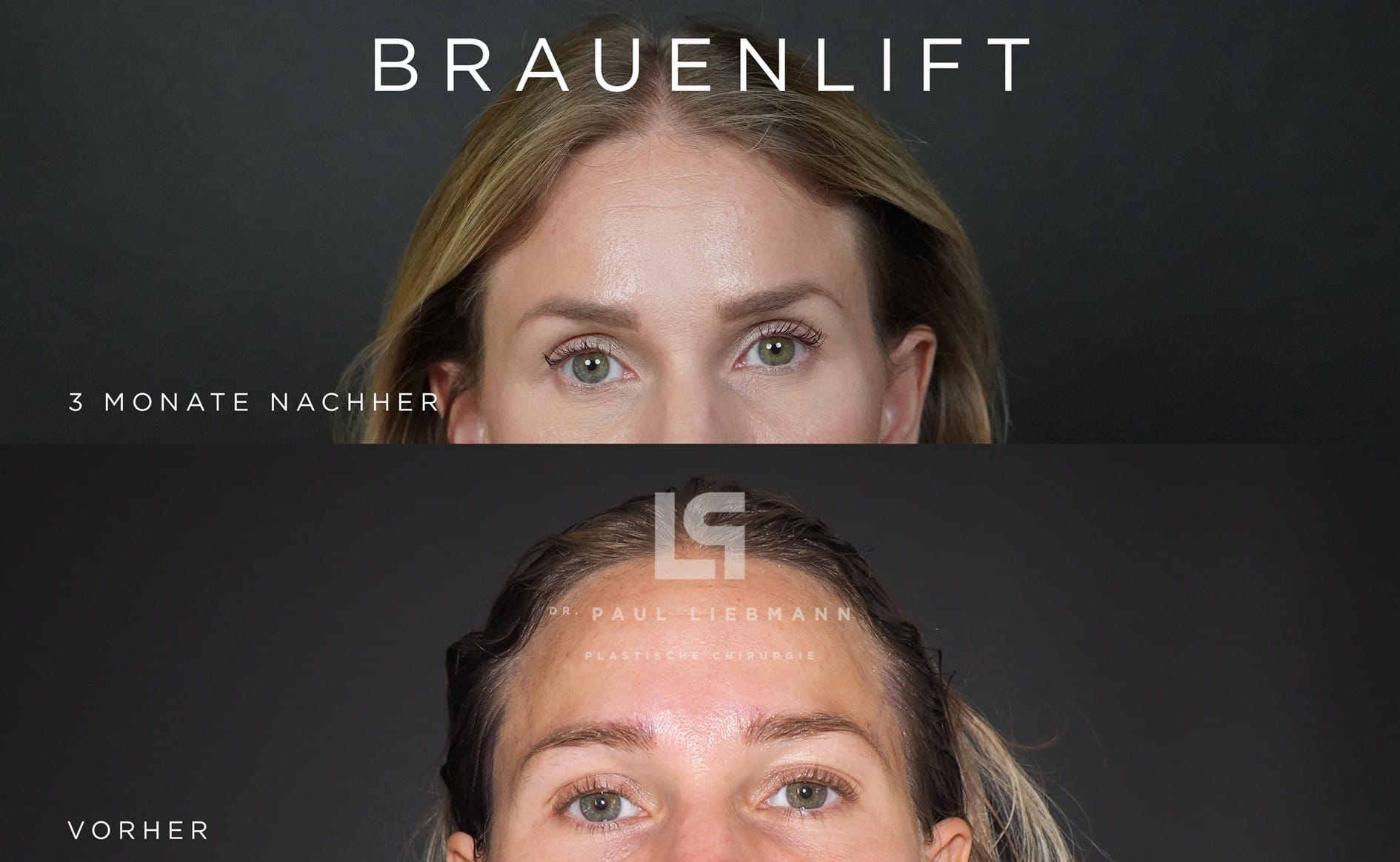 Augenbrauen geliftet vorher und nachher