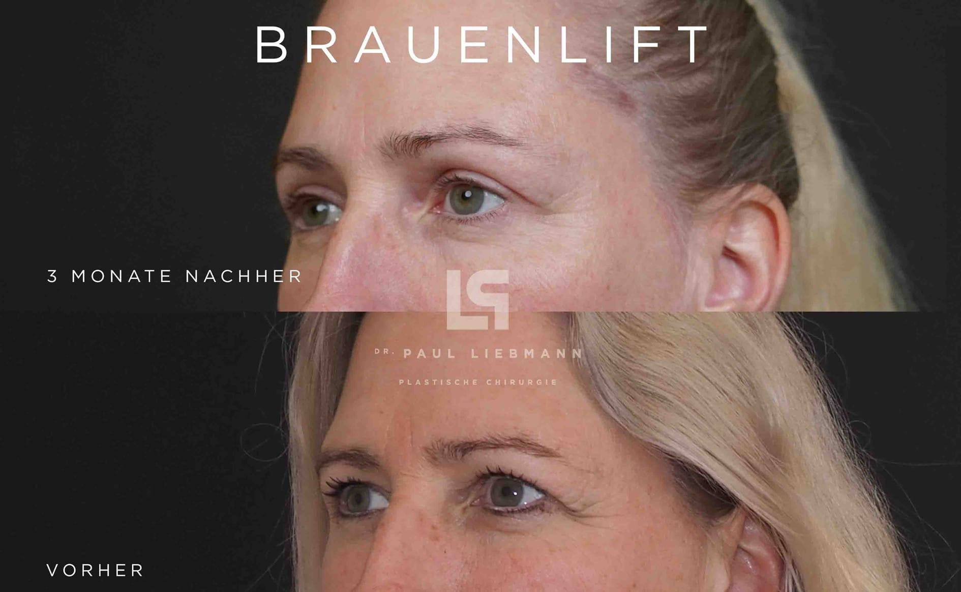 brow lift mit Oberlidstraffung vorher und nachher bzw. vor der Behandlung der Augenbrauen und drei Monate danach