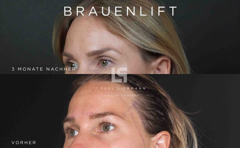 Browlifting vorher nachher