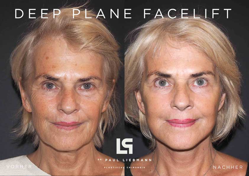 Deep Plane Facelift vorher nachher