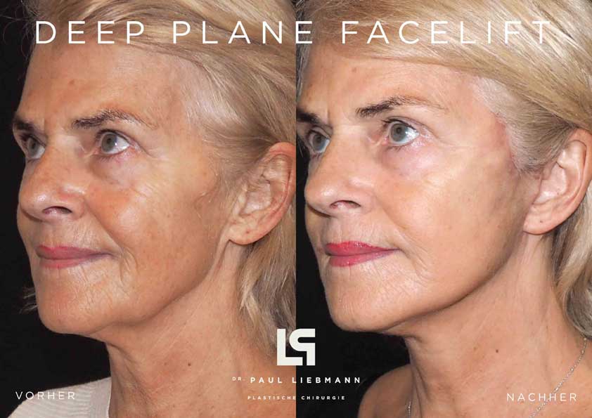 Deep Plane Facelift vorher nachher