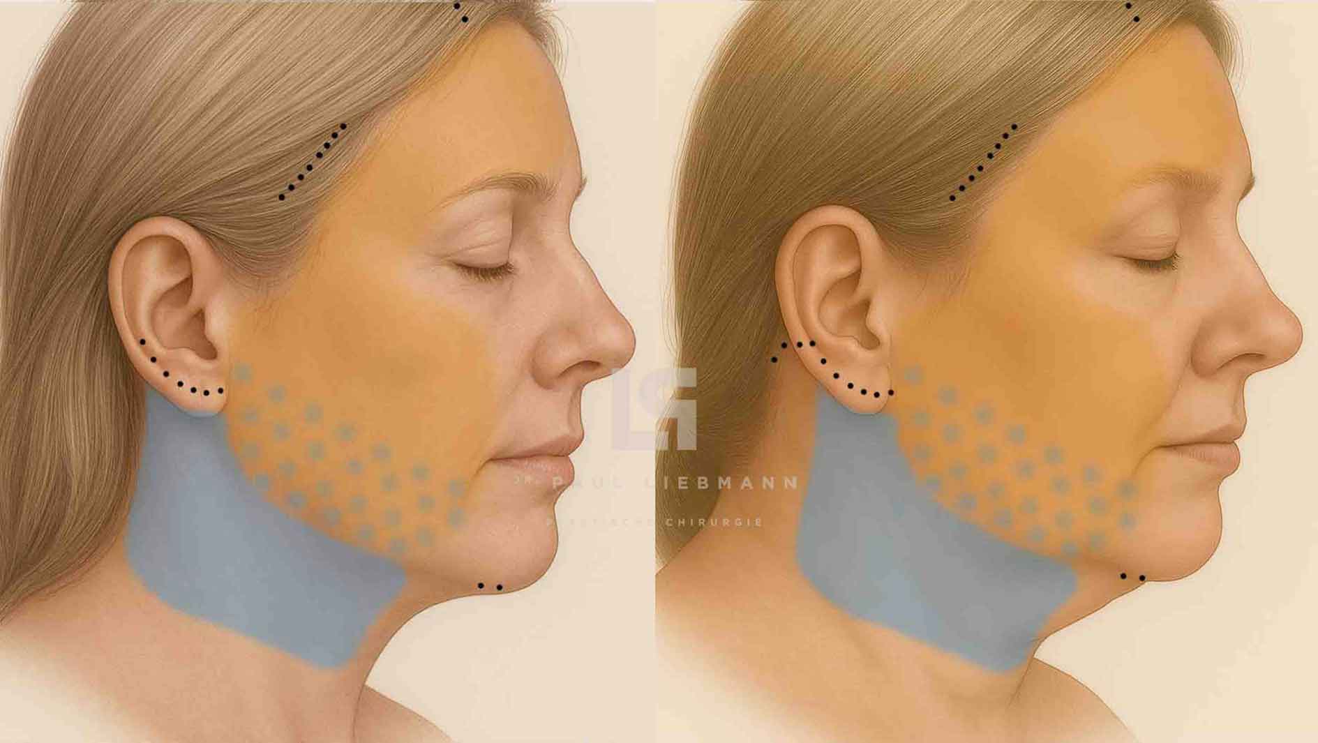 Typ 3a und 3b für Deep Plane