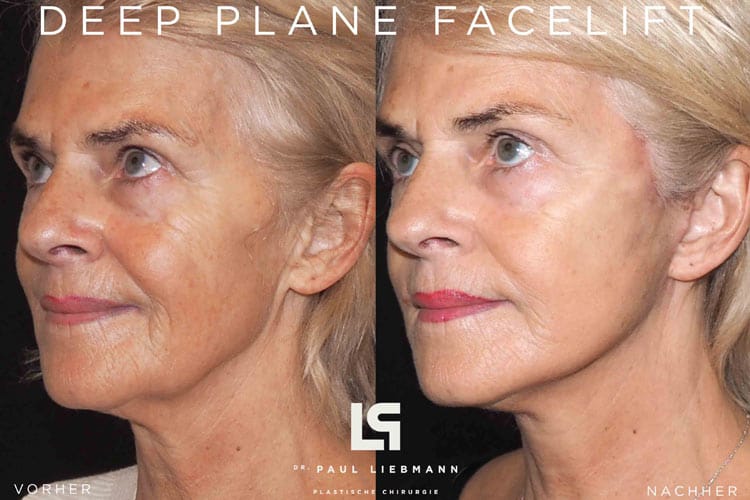 Frau vor und nach einem deep plane facelift in wien von dr. liebmann
